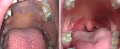 NightLase in Glen Cove