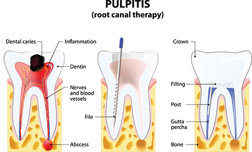 Root Canal in Glen Cove